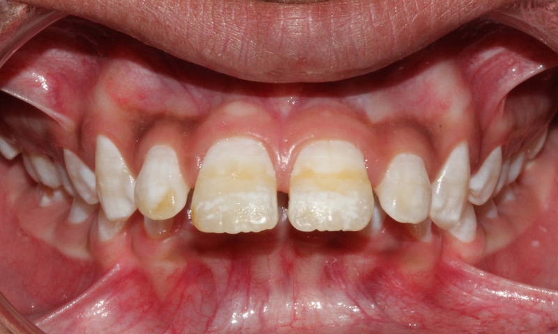 5 nguyên nhân gây ra răng nhô ra