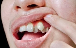 5 nguyên nhân gây ra răng nhô ra
