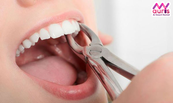Nhổ răng khểnh có nguy hiểm gì không?