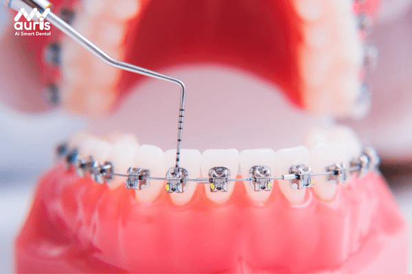 Niềng răng cho răng không đều có phải biện pháp tốt nhất?
