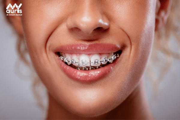 Tìm hiểu cơ chế nguyên lý của niềng răng