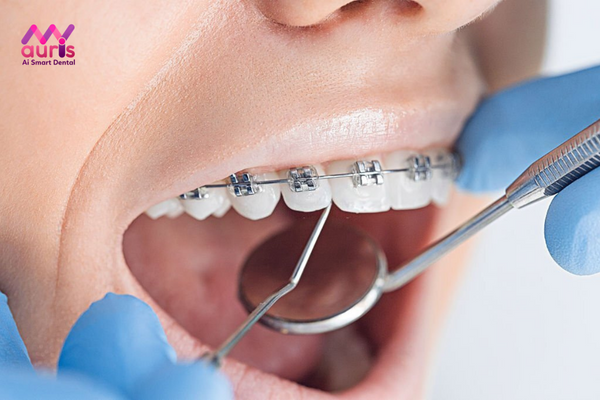 Niềng răng có phải là kỹ thuật gây nguy hiểm cho người bệnh?