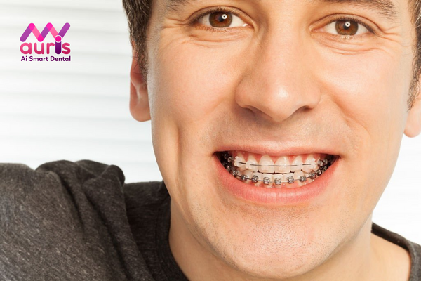 So sánh để lựa chọn niềng răng mắc cài sứ hay kim loại - Điểm giống nhau