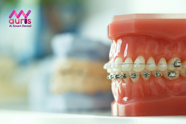 So sánh để lựa chọn niềng răng mắc cài sứ hay kim loại - Điểm khác nhau