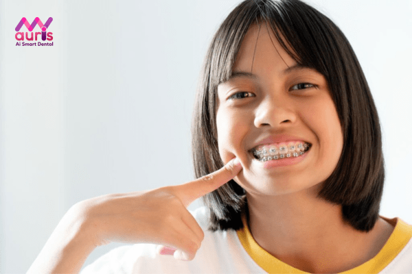 Phải thực hiện niềng răng bao lâu thì có thể tháo niềng?