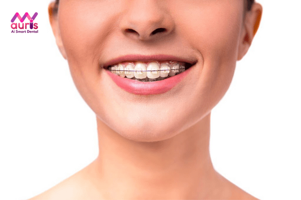 Yếu tố gây ảnh hưởng giá niềng răng mắc cài pha lê